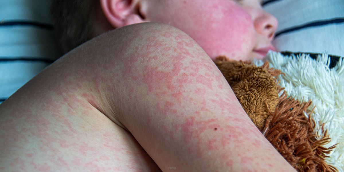 1.7 million Australians are not protected against measles… Is someone you know one of them?